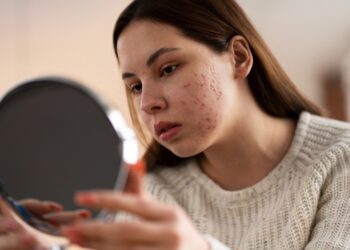 Acne tardia desafia mulheres adultas com lesões persistentes e dolorosas